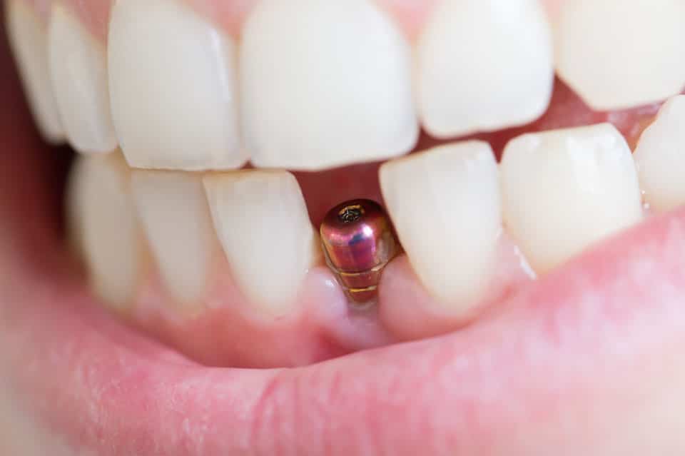 Is it possible to replace all teeth with implants?